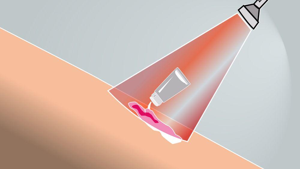 LYSTERAPI: Norsk forskning har funnet en metode som dreper kreftceller i huden ved å kombinere rødt lys med spesielle kjemikalier.