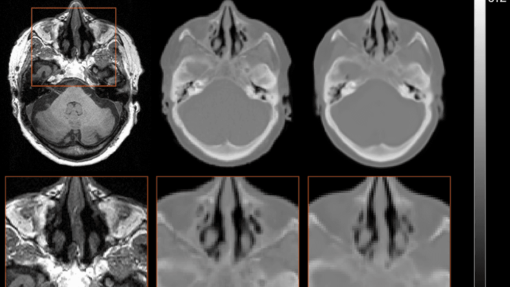 Et MR-bilde som viser bløtdeler med stor kontrast, er standard for de fleste hjerneundersøkelser. Men knokler gir ikke noe signal på MR, og framstår derfor svarte. Hvis man skal ha et reelt bilde med knokler for å lage stråleplaner eller til PET/MR, må man bruke en CT-skanning.
